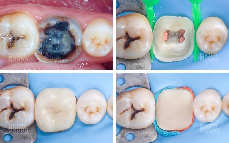 Hình Ảnh Trước Và Sau Khi Lấy Tủy Răng