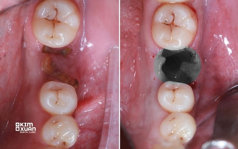 Hình Ảnh Trước Và Sau Khi Nhổ Chân Răng