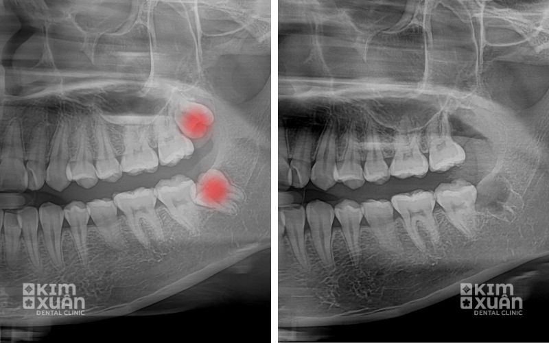Hình Ảnh Trước Và Sau Khi Nhổ Răng Khôn Tại Nha Khoa Kim Xuân