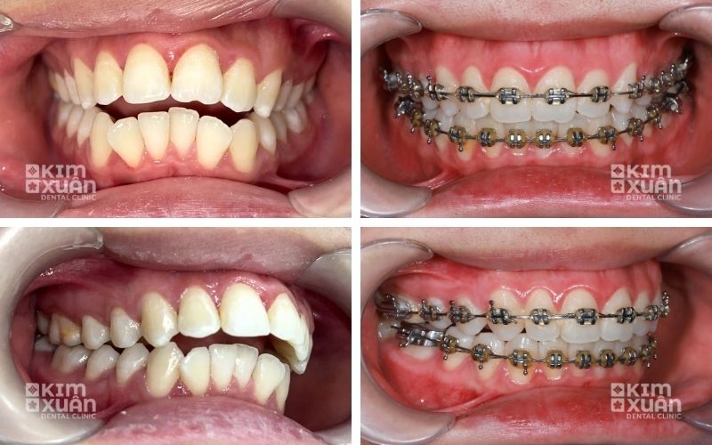 Hình Ảnh Trước Và Sau Khi Niềng Răng Hô Hàm Trên