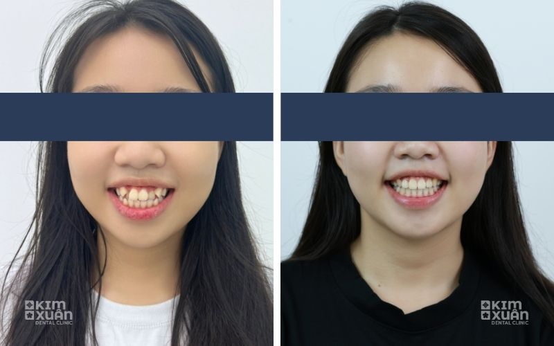 Hình Ảnh Trước Và Sau Khi Niềng Răng Hô Tại Nha Khoa Kim Xuân