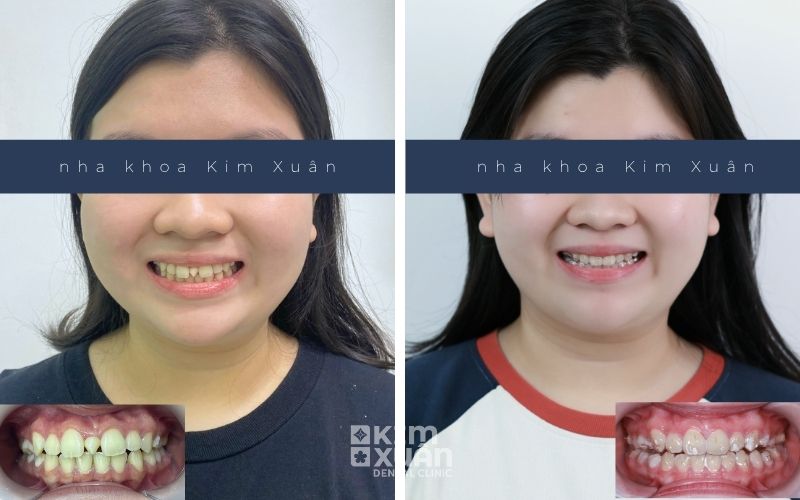 Hình Ảnh Trước Và Sau Khi Niềng Răng Invisalign Tại Nha Khoa Kim Xuân