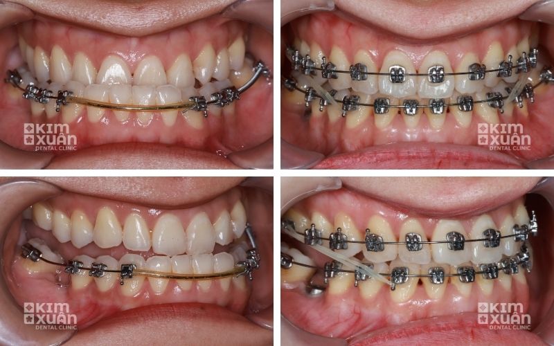 Hình Ảnh Trước Và Sau khi Niềng Răng Móm Tại Nha Khoa Kim Xuân