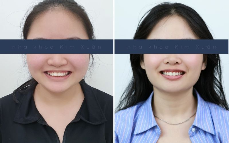 Hình Ảnh Trước Và Sau Khi Niềng Răng Ở Tuổi 17 Tại Nha Khoa Kim Xuân