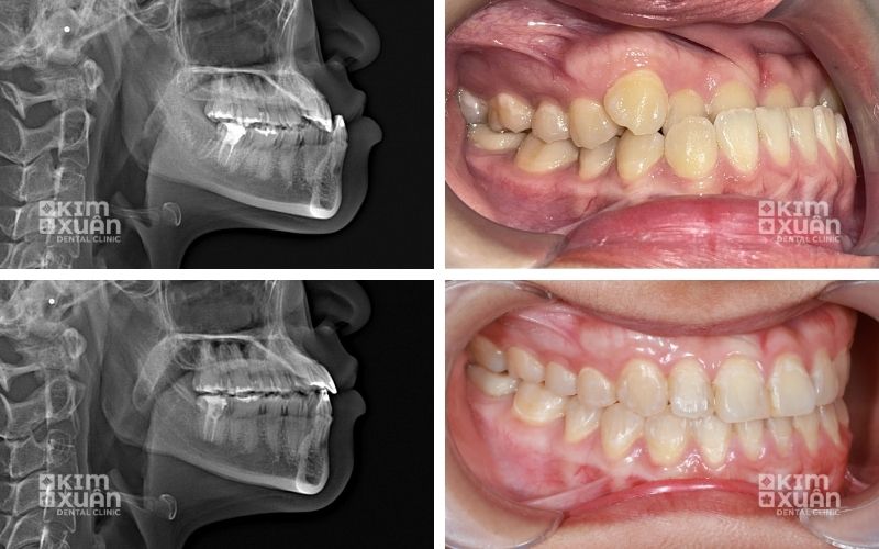 Hình Ảnh Trước Và Sau Khi Niềng Răng Ở Tuổi 17