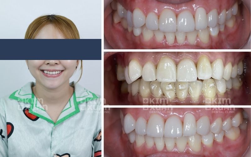 Hình Ảnh Trước và Sau Khi Niềng Răng Ở Tuổi 30