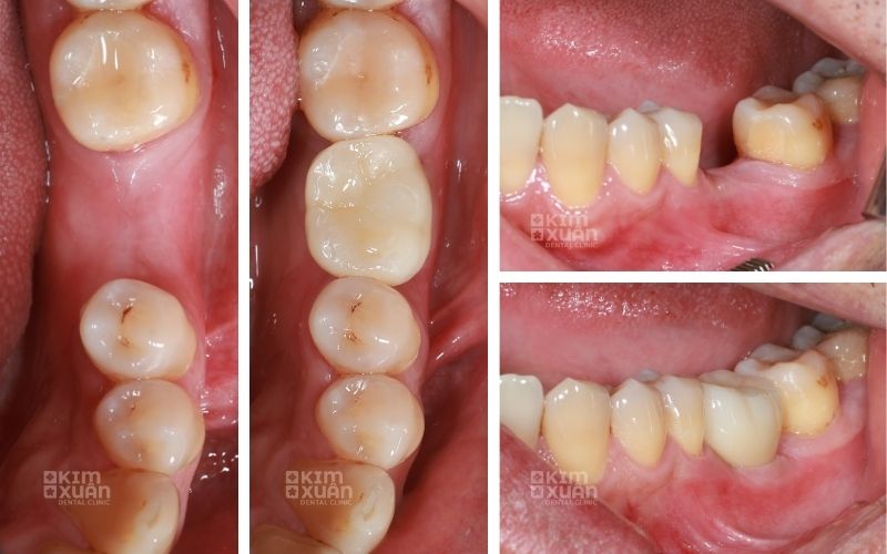 Hình ảnh trước và sau khi phục hình chân răng đã mất