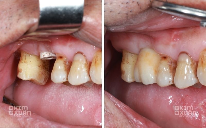 Hình Ảnh Trước Và Sau Khi Phục hình Răng Hàm Bị Sâu Chỉ Còn Chân Răng