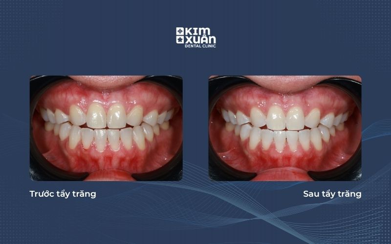 Hình ảnh truóc và sau khi tẩy trắng răng tại nha khoa Kim Xuân
