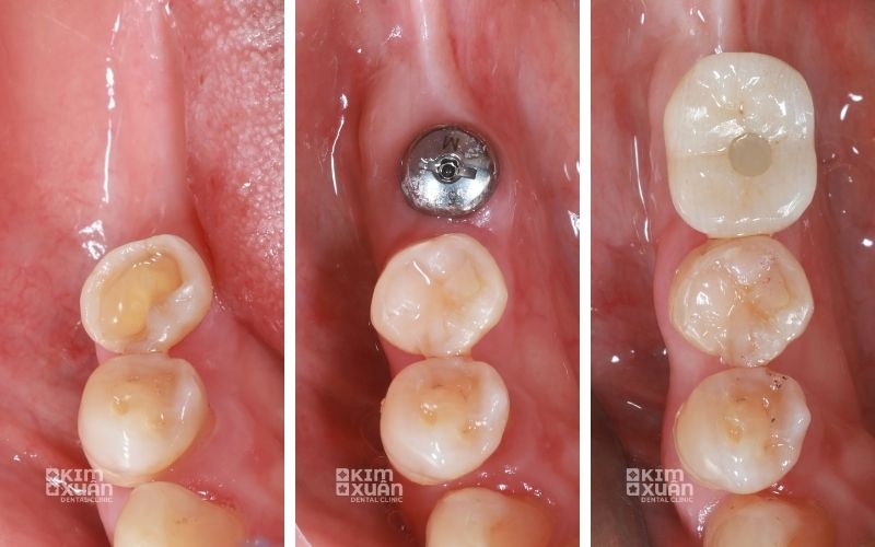 Hình ảnh trước và sau khi trồng răng hàm số 6