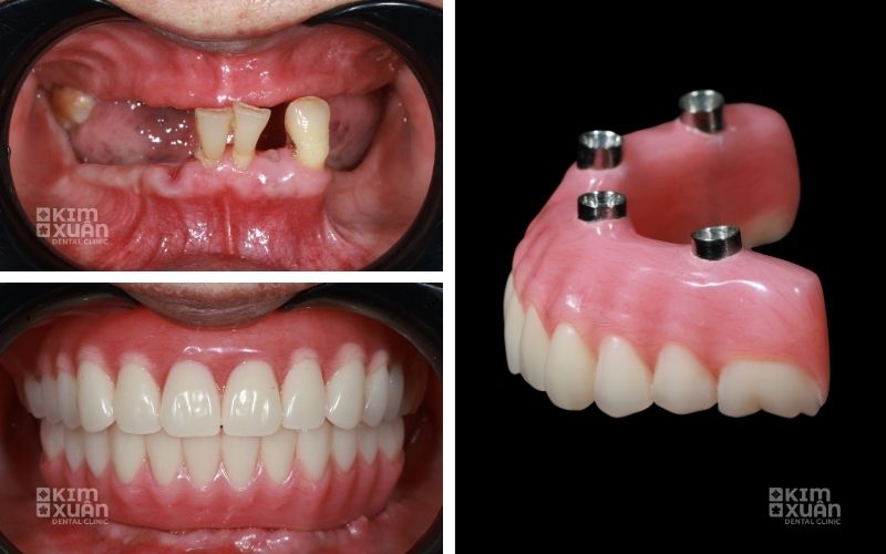 Hình Ảnh Trước Và Sau Khi Trồng Răng Implant Tại Nha Khoa Kim Xuân