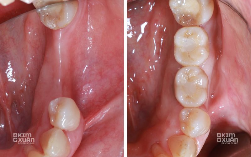 Hình ảnh trước và sau khi trồng răng hàm số 6 tại nha khoa kim xuân