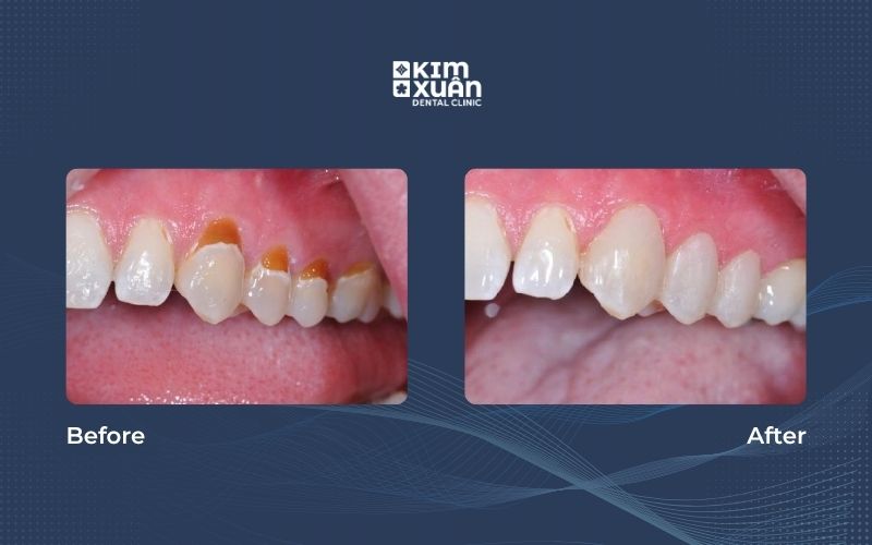 Hình ảnh trước và sau khi trám mòn cổ chân răng