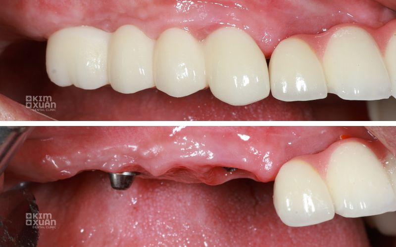 Hình ảnh trước và sau khi trồng răng implant khi chân răng đã mất