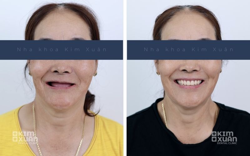 Hình Ảnh Trước Và Sau Trồng Răng Implant Tại Nha Khoa Kim Xuân