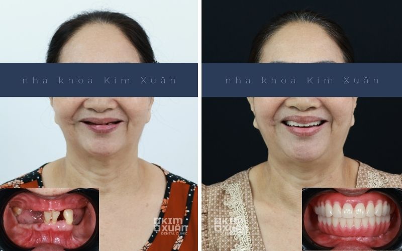 Hình Ảnh Trước Và Sau Khi Trồng Răng Implant Tại Nha Khoa Kim Xuân