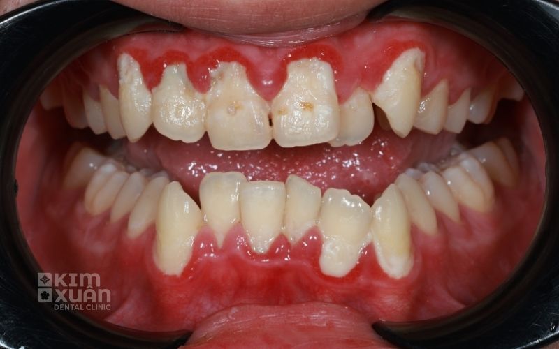 Hình Ảnh Nướu Sưng Đỏ