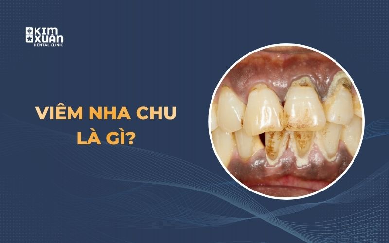 Hình ảnh viêm nha chu