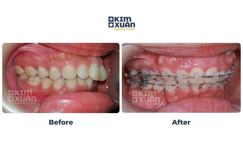 Hô Hàm Trên Có Niềng Răng Được Không