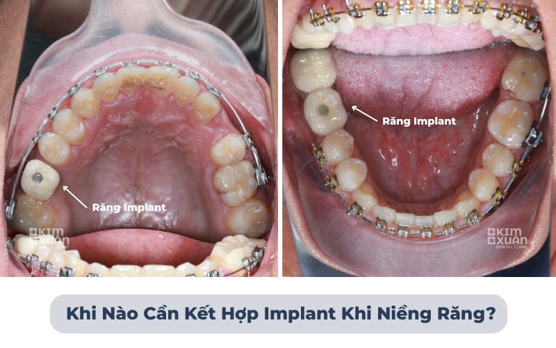 Niềng răng kết hợp Implant cho bệnh nhân mất răng