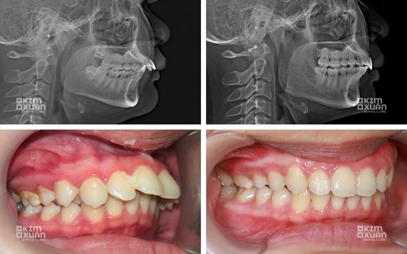Hình ảnh trước và sau điều trị niềng răng hô