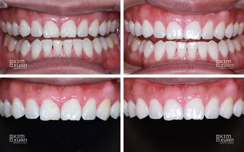 Hình ảnh trước và sau tẩy trắng răng tại nha khoa