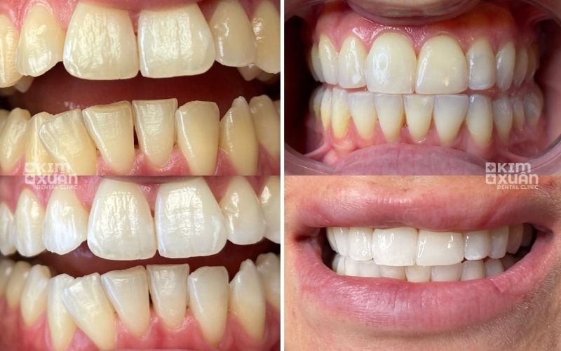 Hình ảnh so sánh trước và sau tẩy trắng răng cho thấy sự cải thiện rõ rệt về màu răng và nụ cười