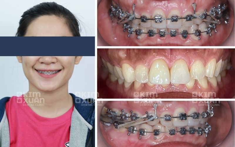 Khách Hàng 30 Tuổi Niềng Răng Tại Nha Khoa Kim Xuân
