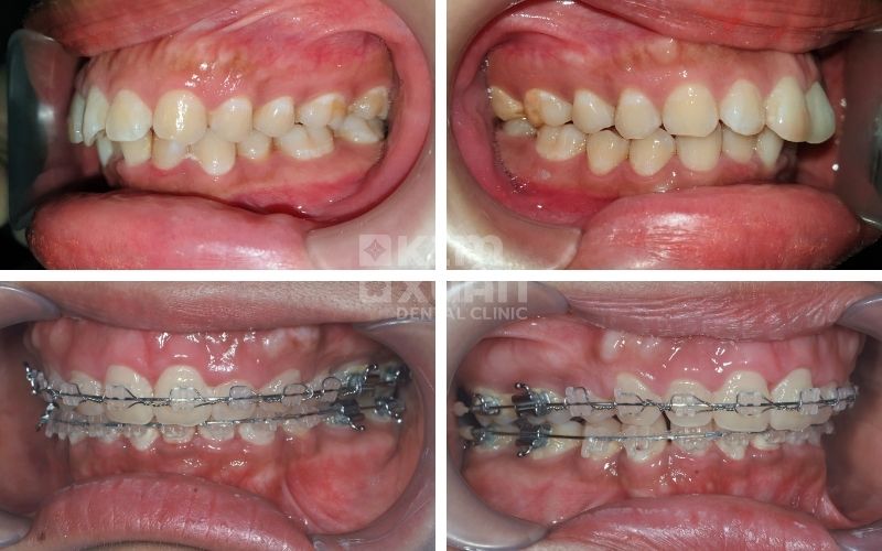 Trước và sau khi niềng răng hô với mắc cài sứ thẩm mỹ