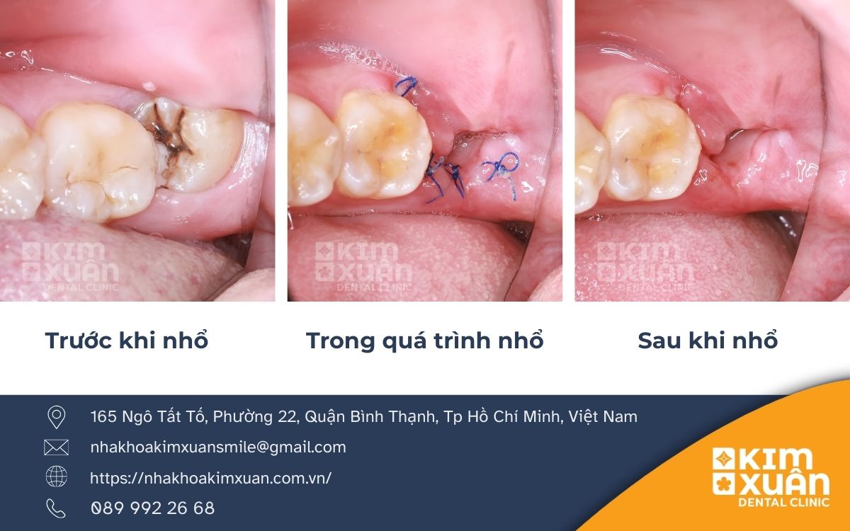 Khi Nào Bạn Nên Nhổ Răng Khôn