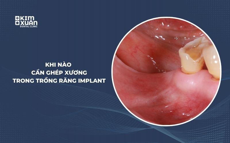 Khi Nào Cần Ghép Xương Trong Trồng Răng Implant