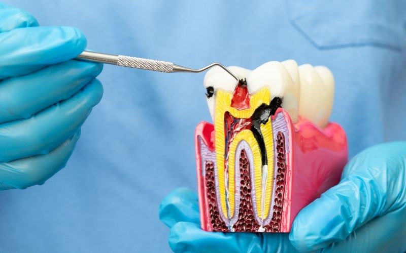 Khi Nào Cần Lấy Tủy Răng