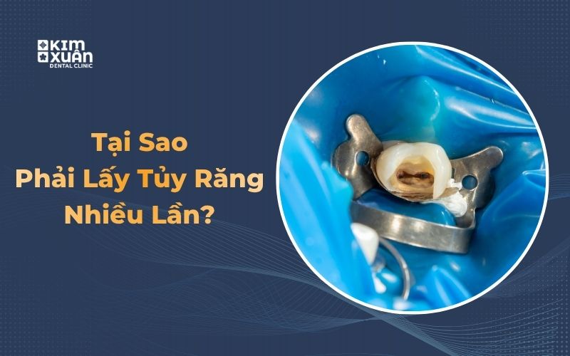 Khi Nào Cần Lấy Tủy Răng