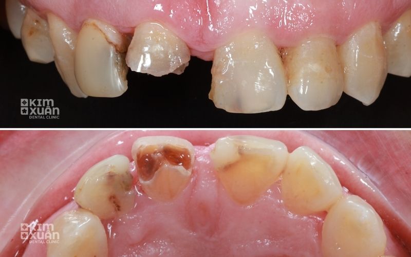 Khi Nào Cần Nên Lấy Tủy Sớm