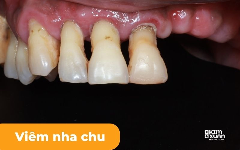 Khi nào Cần Phải Nhổ Răng