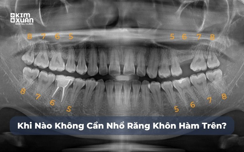Khi nào không cần nhổ răng khôn hàm trên