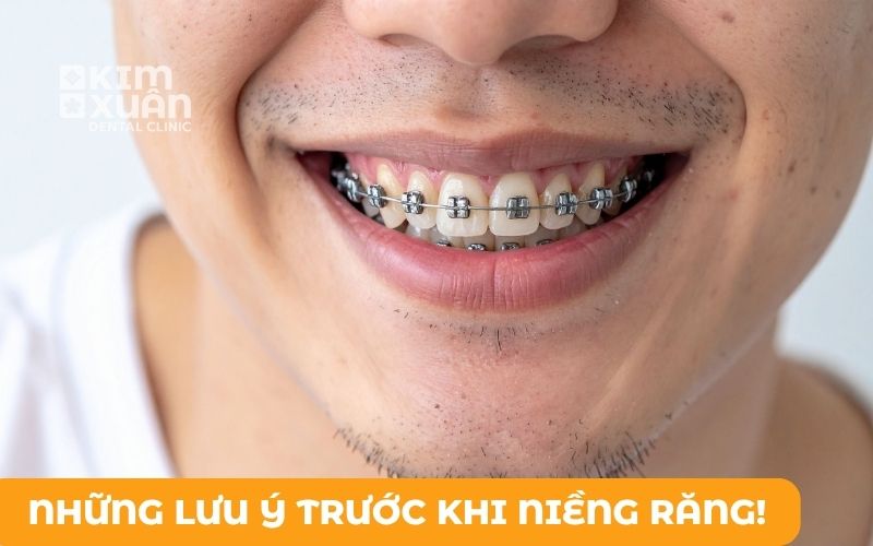 Khi Nào Không Nên Niềng Răng