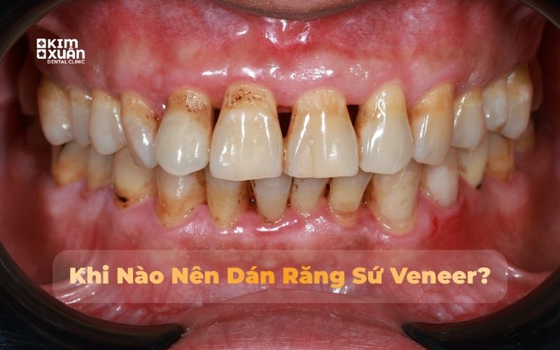 Khi nào nên dán răng sứ veneer