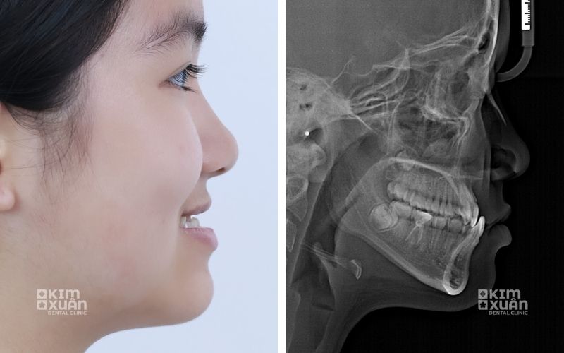 Khớp cắn ngược có sao không
