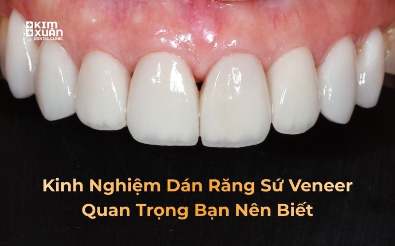 Kinh nghiệm dán răng sứ veneer mà bạn cần biết