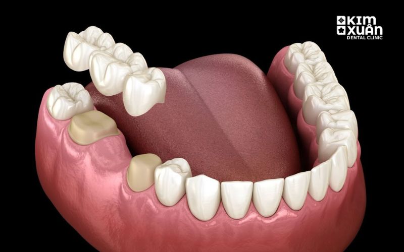 Làm Cầu Răng Sứ Bao Nhiêu Tiền Tại TP. HCM