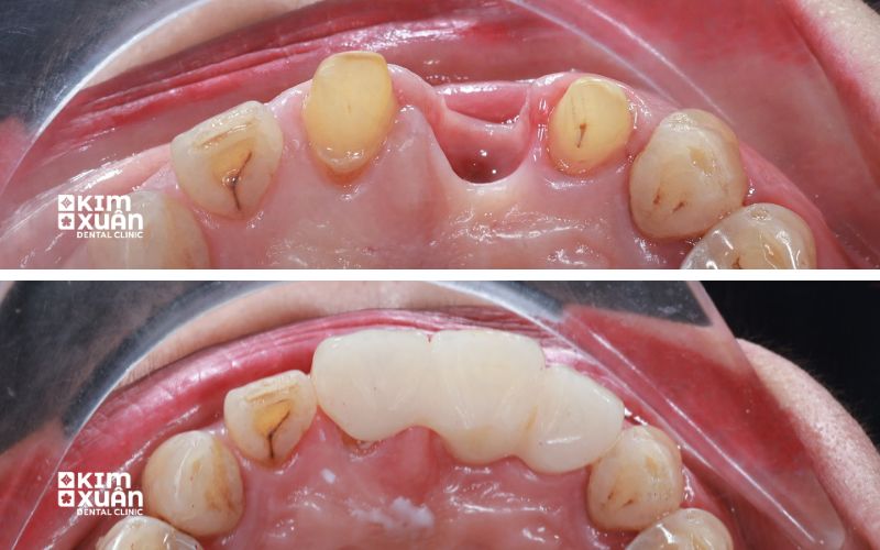 Làm Cầu Răng Sứ Có Bền Không
