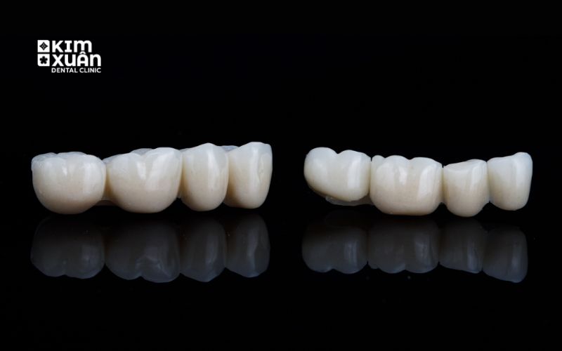Làm Cầu Răng Sứ Có Bền Không