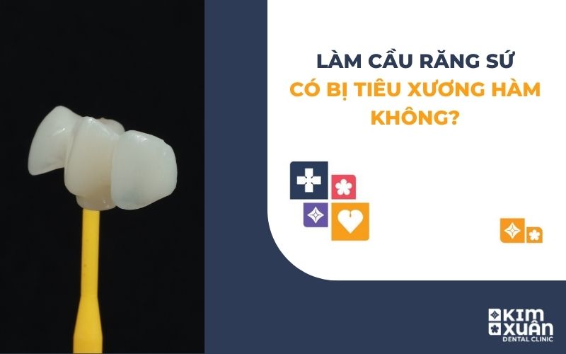 Làm Cầu Răng Sứ Có Bị tiêu Xương Hàm Không