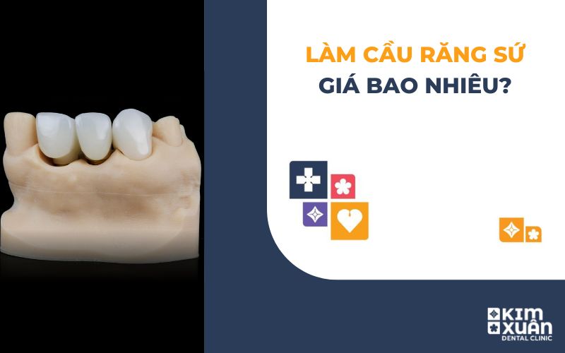 Làm Cầu Răng Sứ Giá Bao Nhiêu