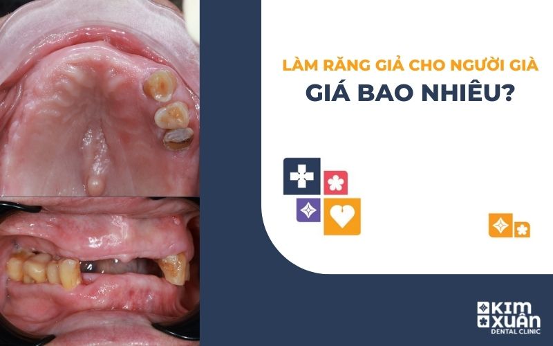 Làm Hàm Răng Giả Cho Người Già Giá Bao Nhiêu Tiền