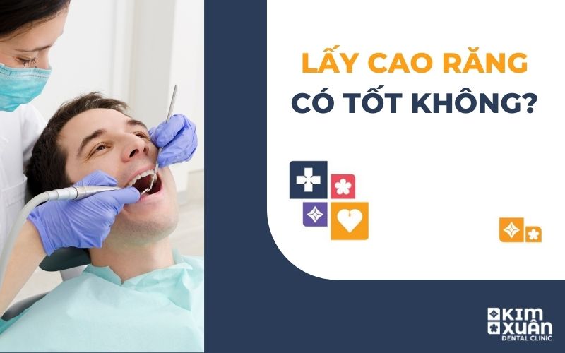 Lấy Cao Răng Có Tốt Không