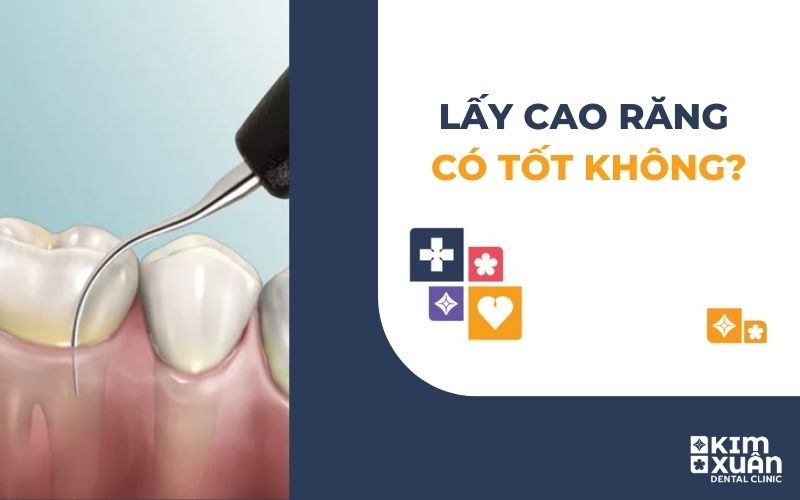 Lấy Cao Răng Có Tốt Không