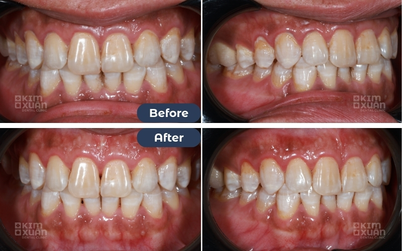 Lấy Cao Răng Giá Bao Nhiêu Tại Bình Thạnh