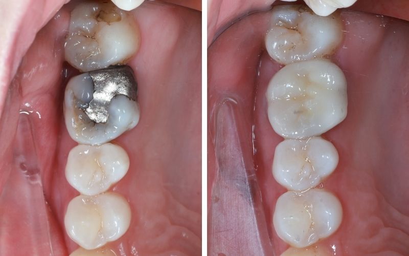 Lấy Tủy Răng Bọc Răng Sứ Có Bền Không